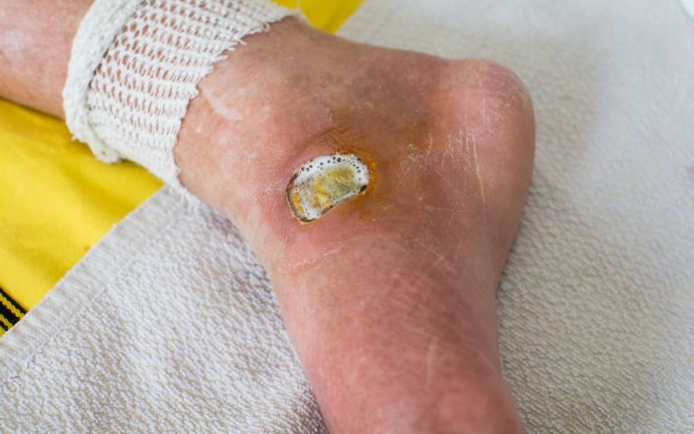 Understanding Diabetic Foot Wounds