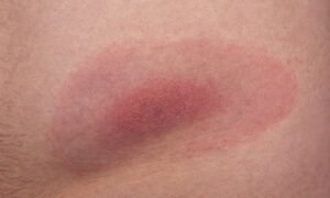 Hyperbaric Chamber for Lyme Disease: Does It Really Work?
