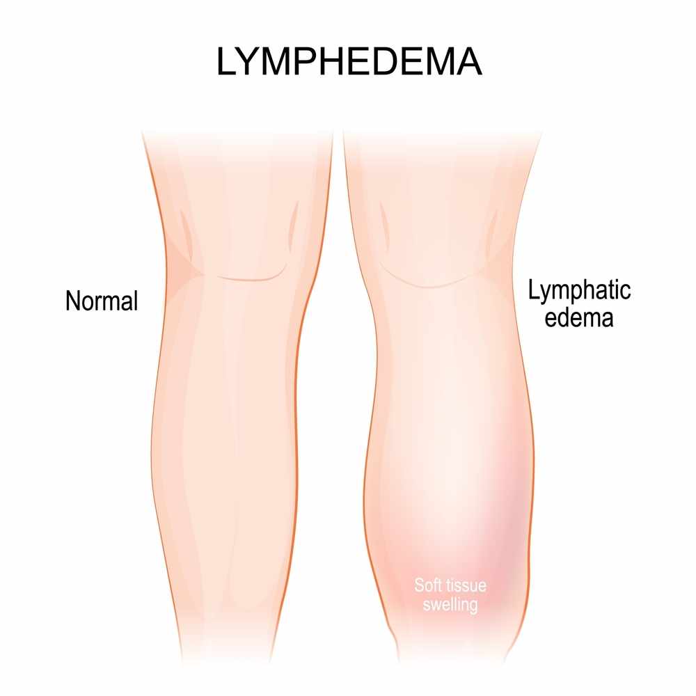 Lymphedema