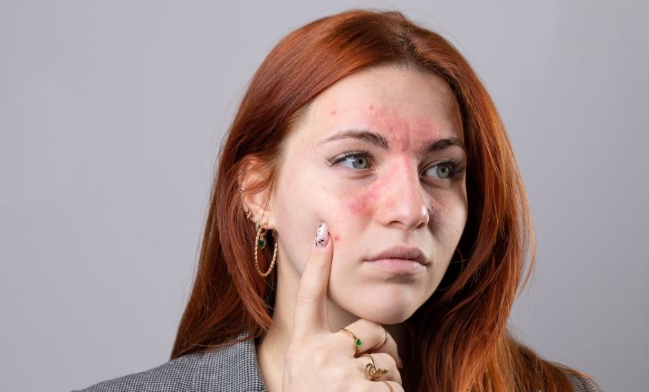 Red Light Therapy for Eczema