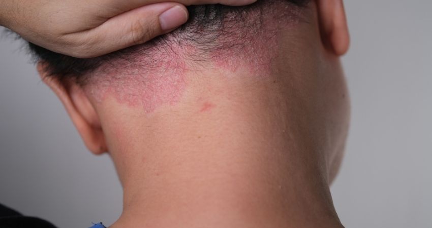 Red Light Therapy for Psoriasis
