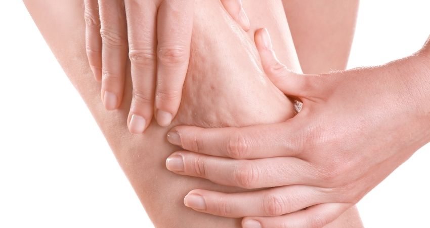 cellulite