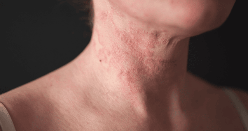 eczema