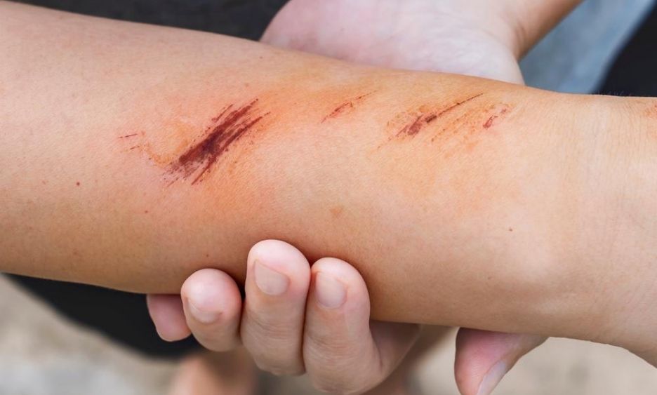 Hyperbaric Oxygen Therapy For Wound Healing