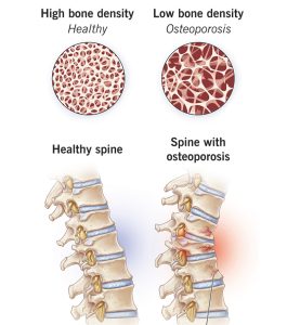 PEMF Bone Health: Surprising 2025 Study on Bone Marrow Fat